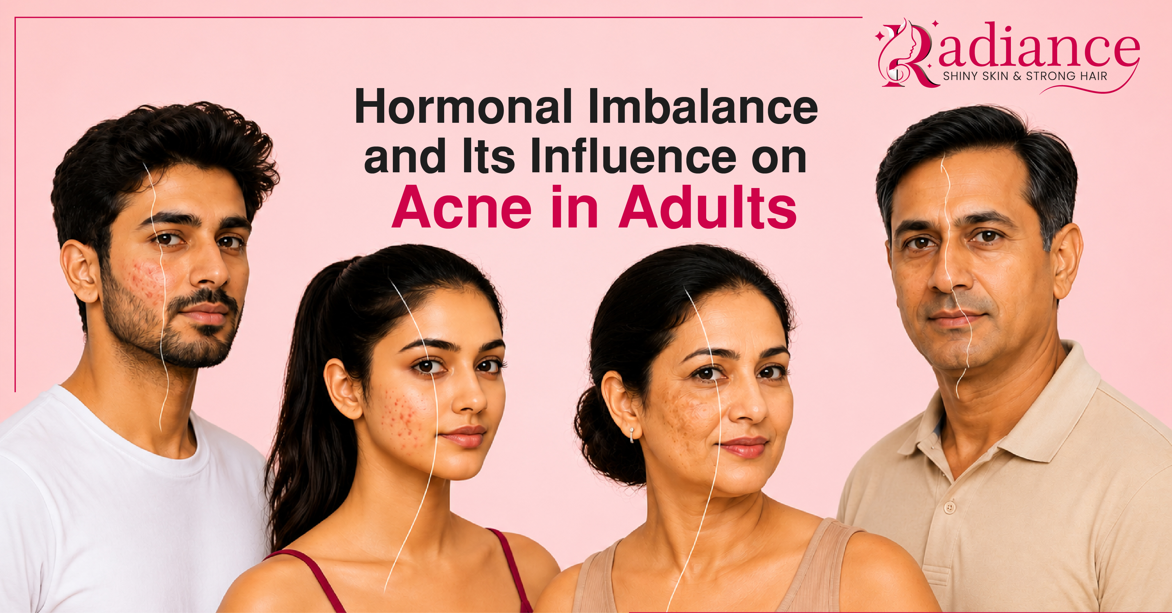 Hormonal Acne in Adults: Causes, Symptoms & Treatment