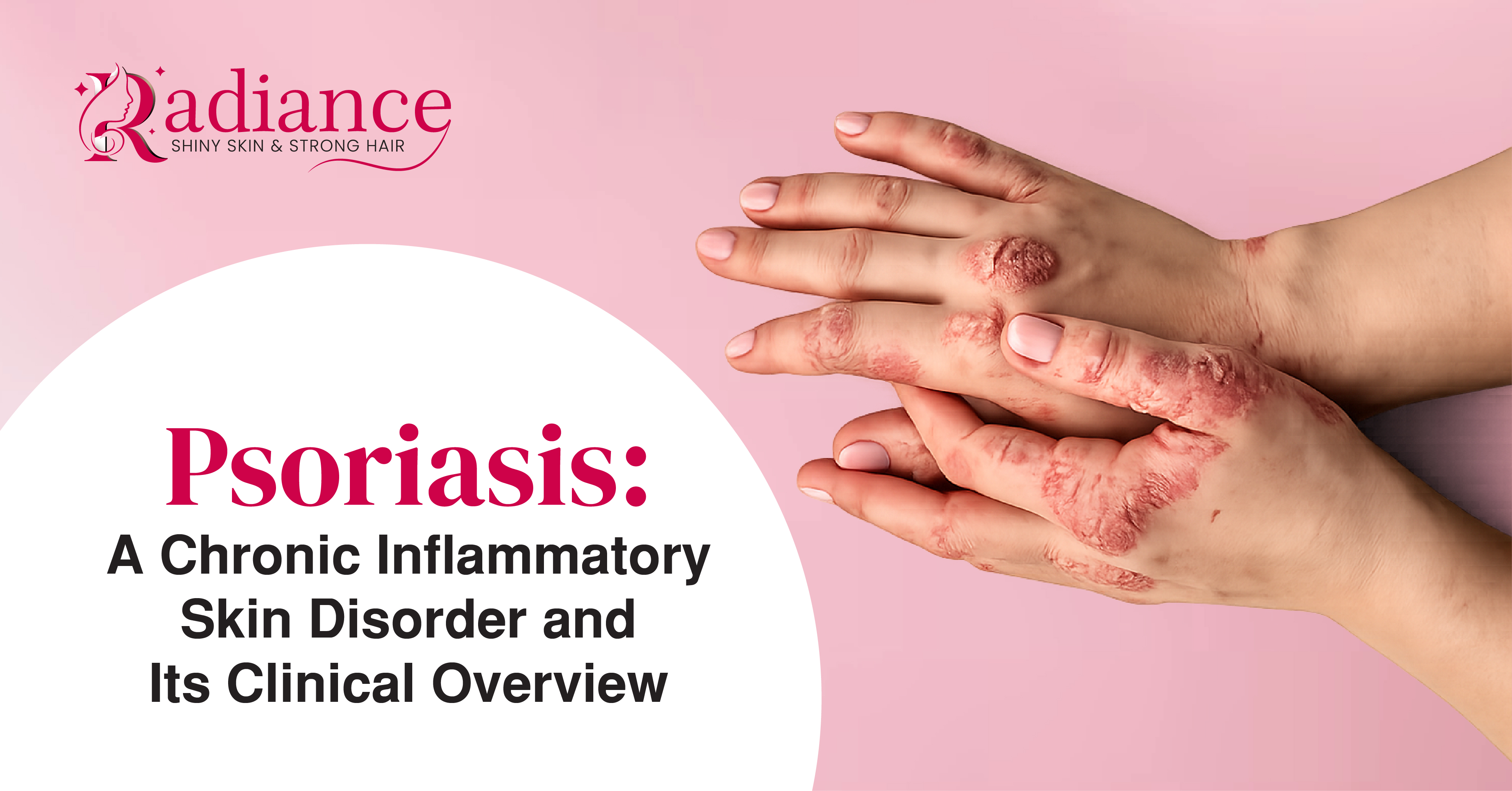 Psoriasis: Causes, Symptoms, Triggers & Treatment Guide